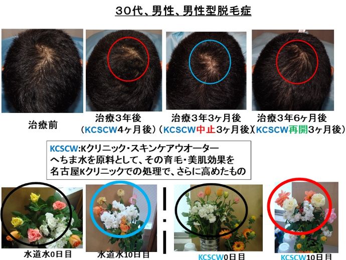 円形脱毛症　病院